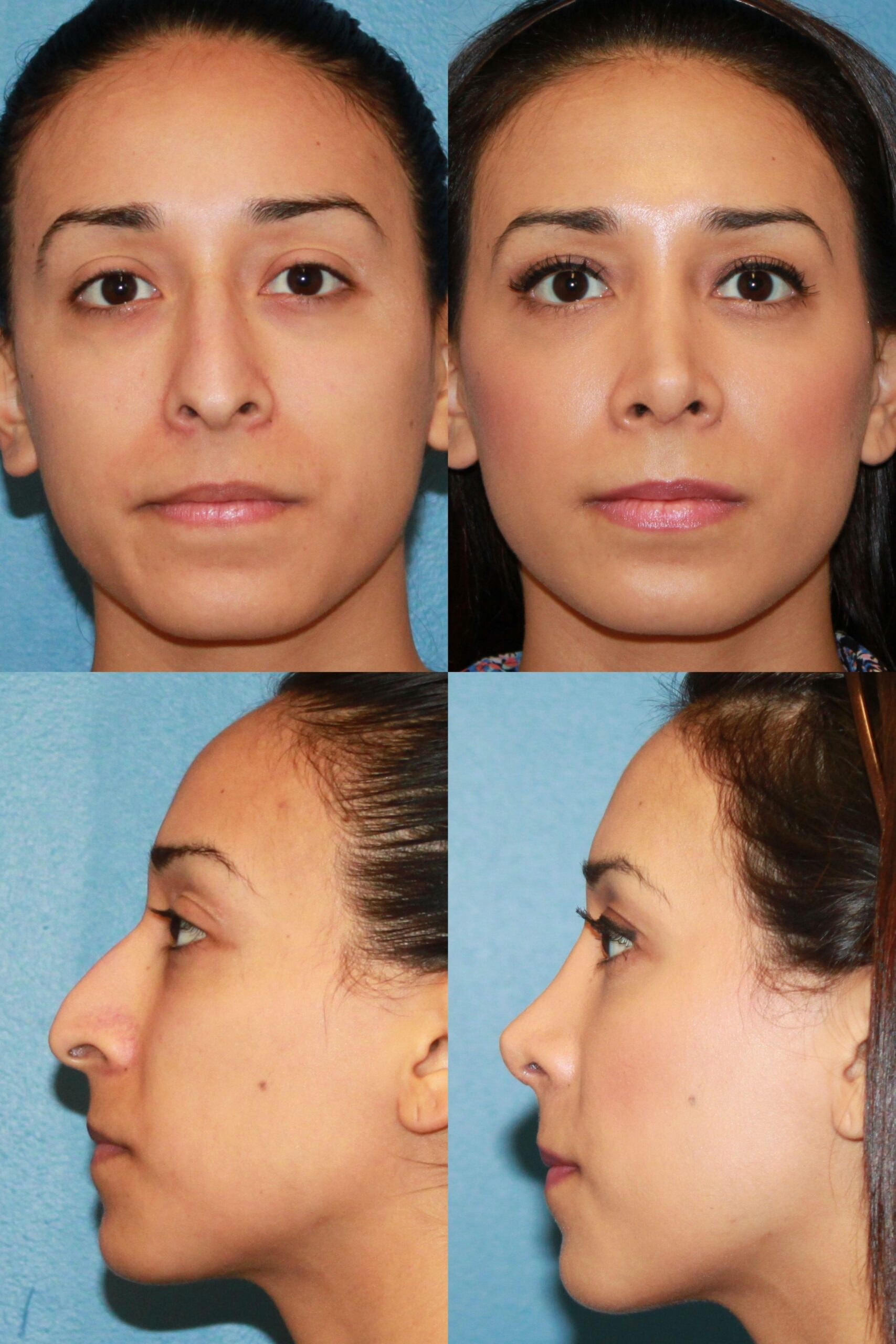 revision rhinoplasty expert los angeles