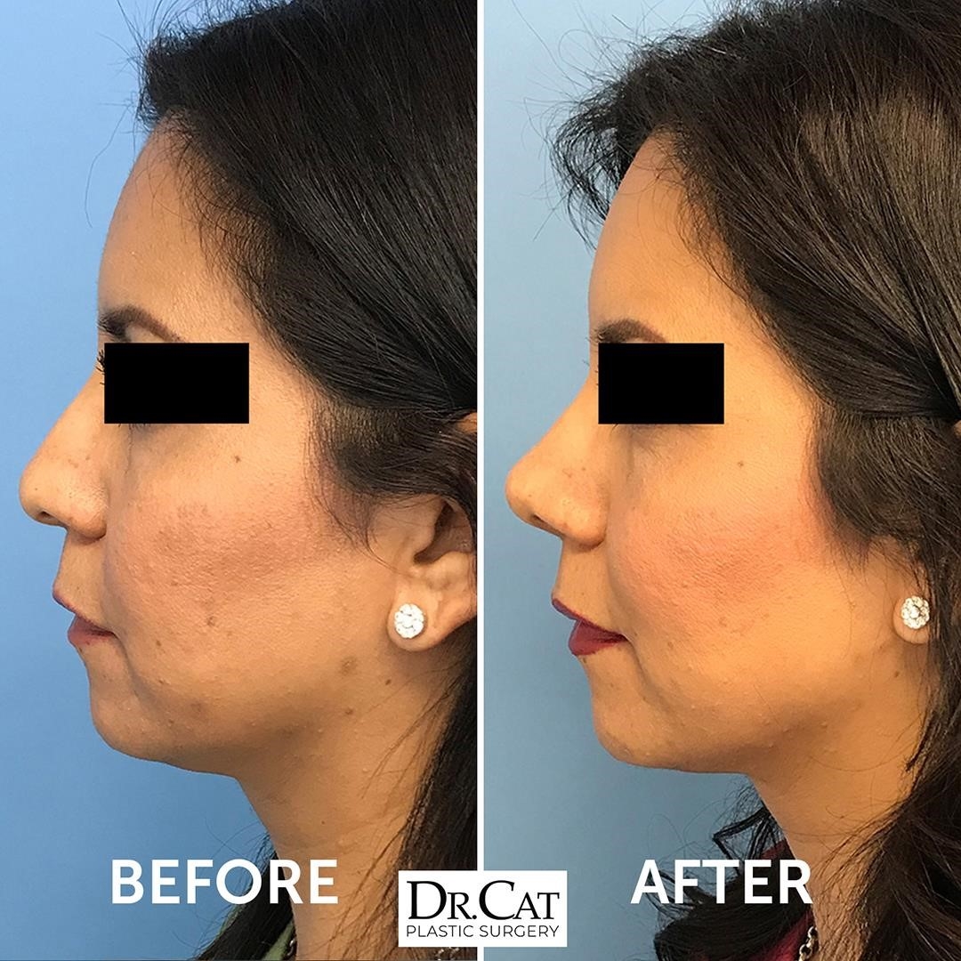 revision rhinoplasty expert los angeles